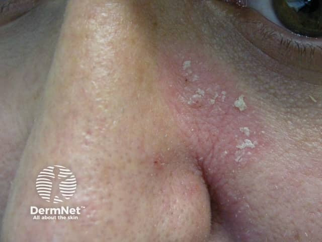 Psoriasis Triggers and Flare-Ups: Why Symptoms Suddenly Get Worse