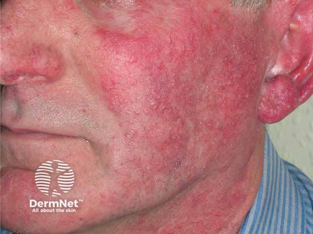 rosacea on a man's cheek