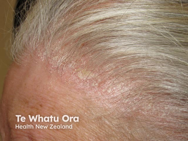 scalp psoriasis