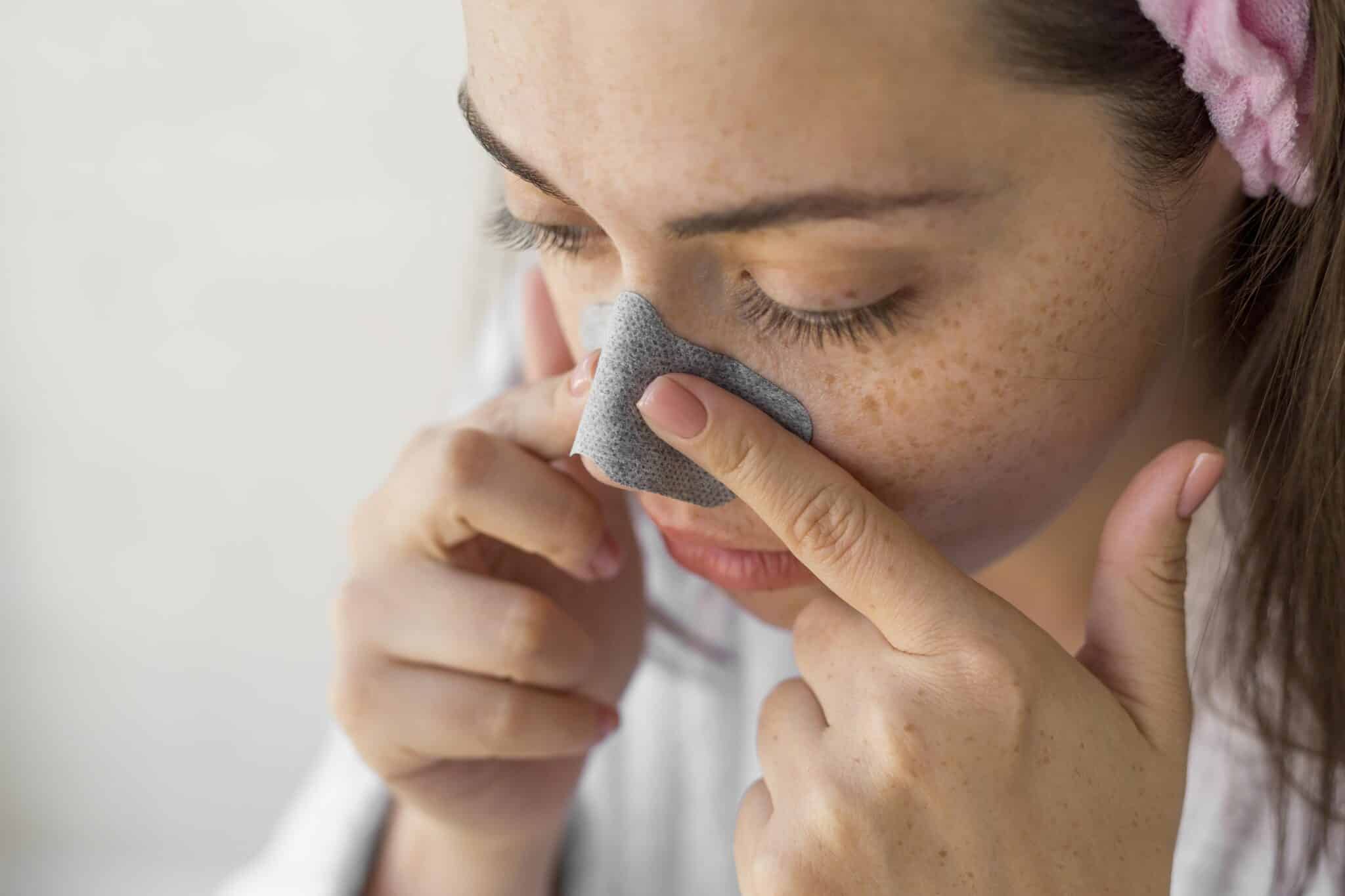 woman with Seborrheic dermatitis around the nose