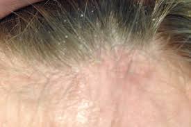 Seborrheic Dermatitis in a man's hair