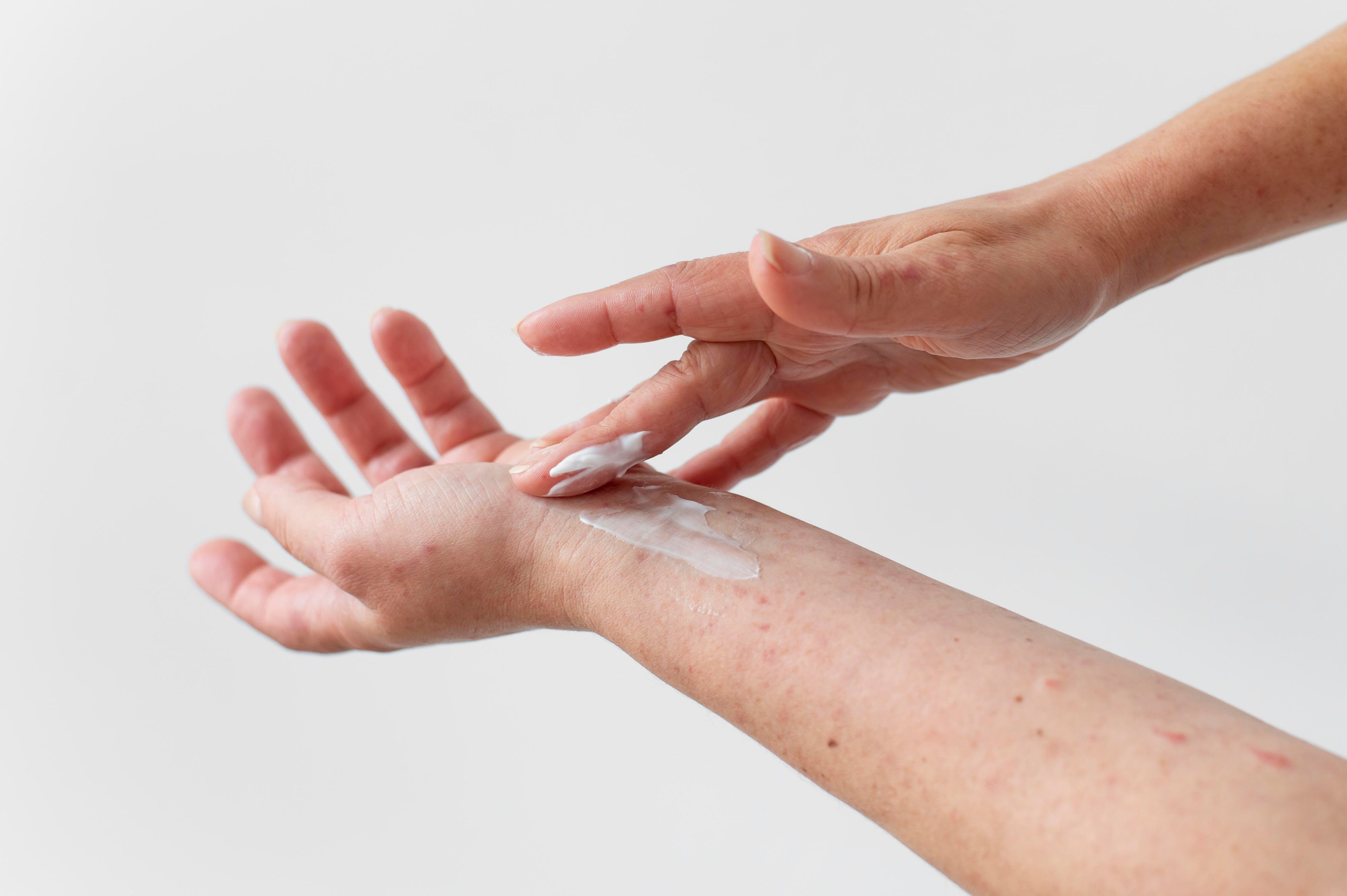 blisters on hands