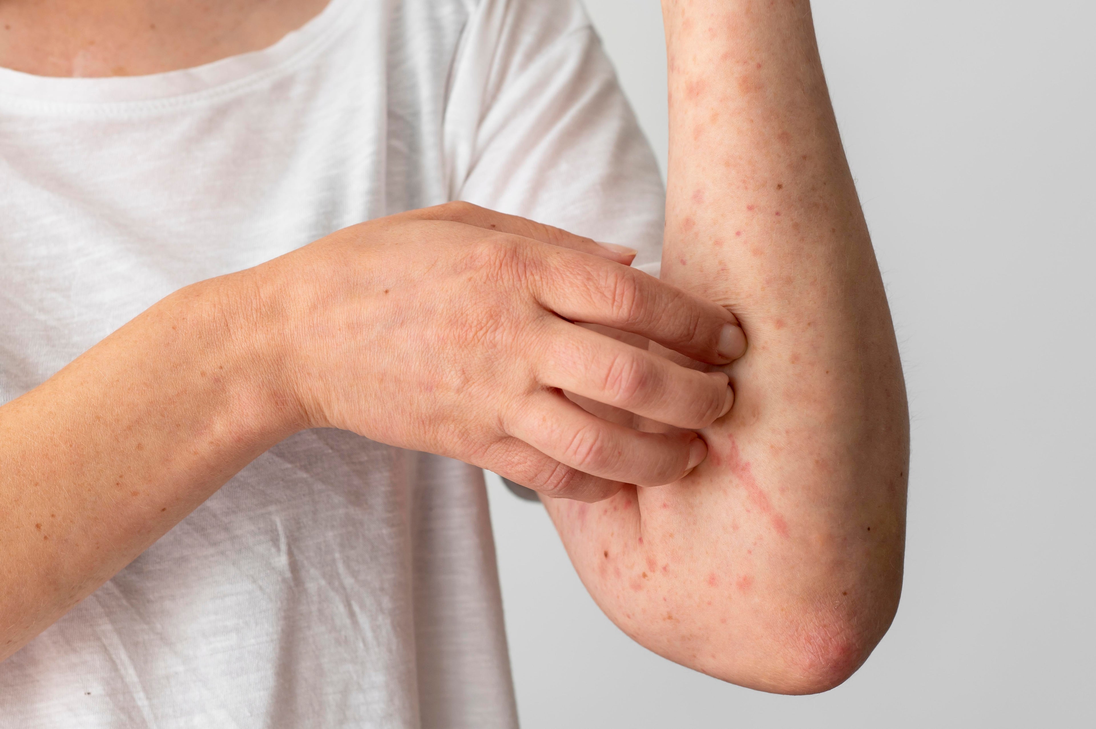 eczema itching
