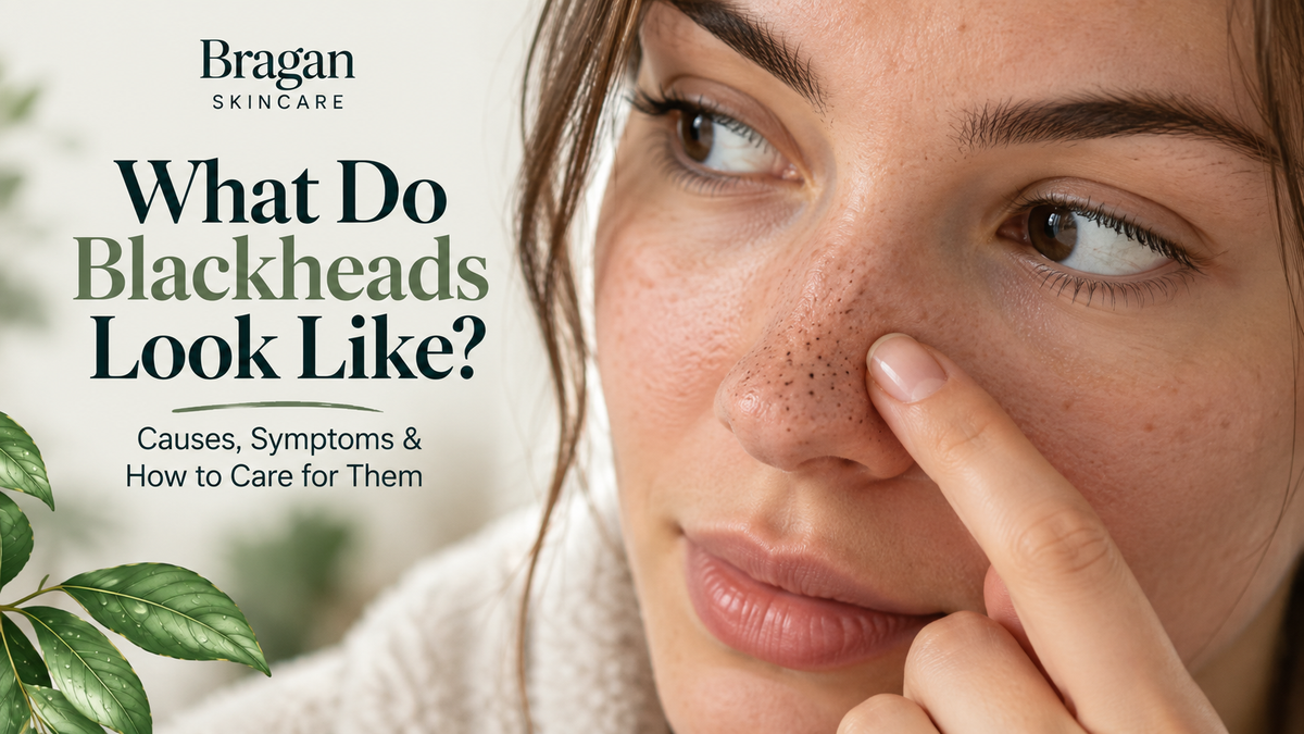 Close-up of a woman’s face showing blackheads around the nose, with text explaining what blackheads look like, their causes, symptoms and skincare.