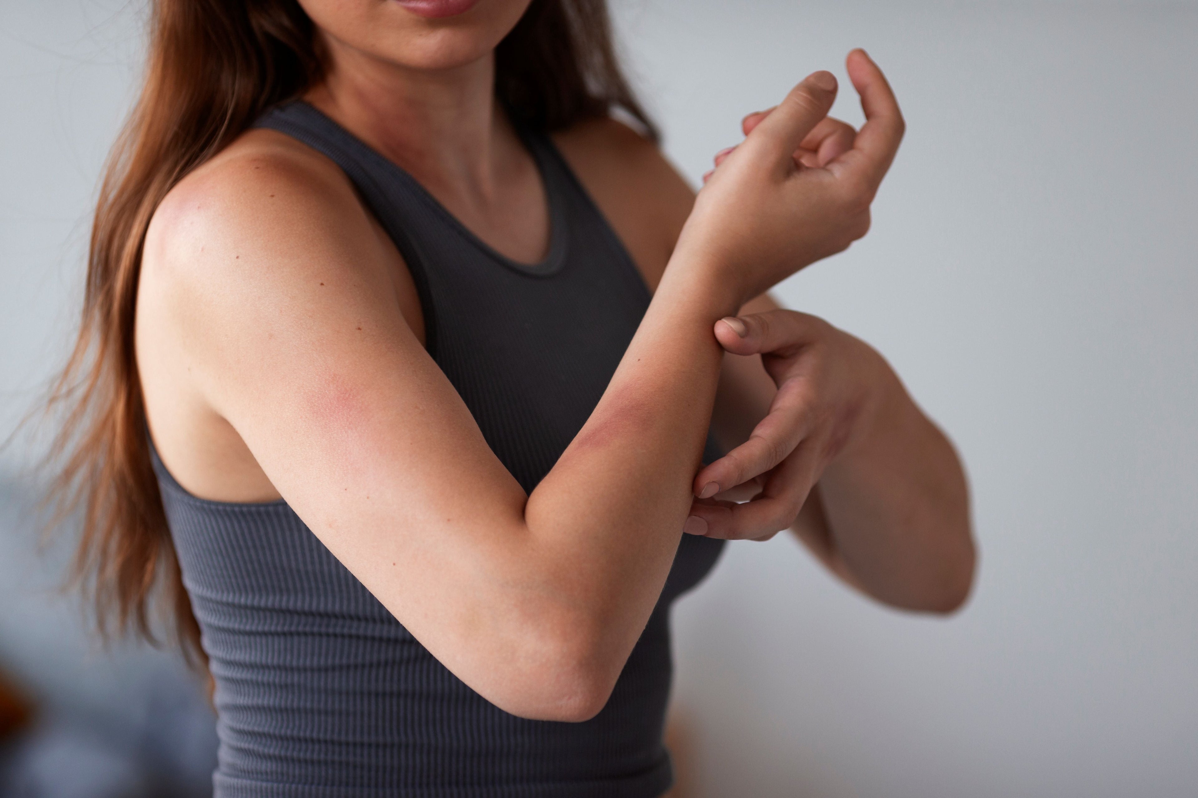skin stinging from eczema cream