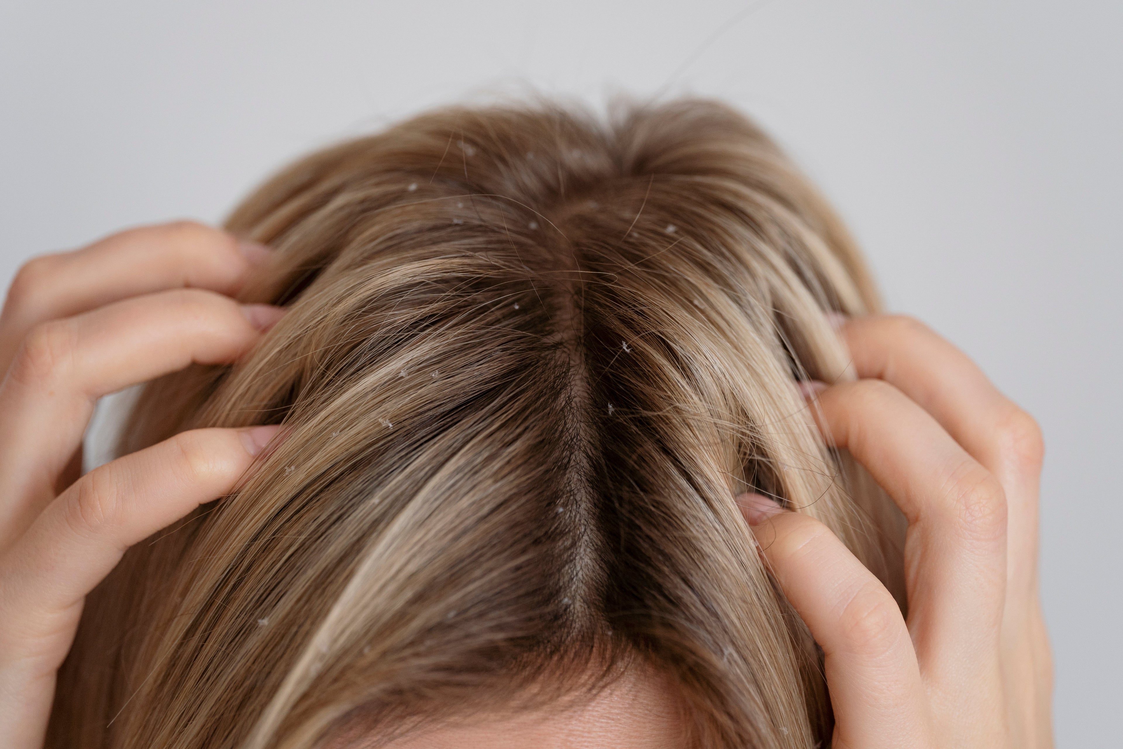 woman showing her irritated scalp