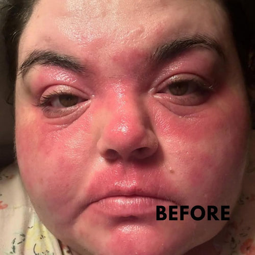 Atopic Cream for Sensitive & Irritated Skin