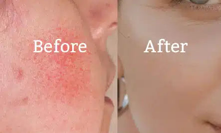 Atopic Cream for Sensitive & Irritated Skin