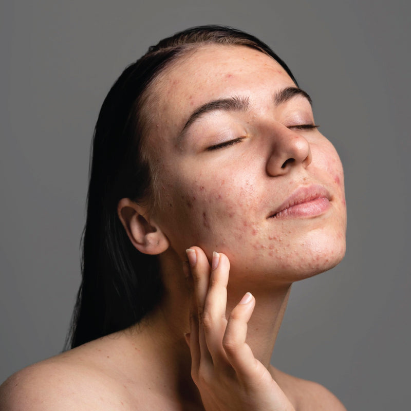 Acne Relief
