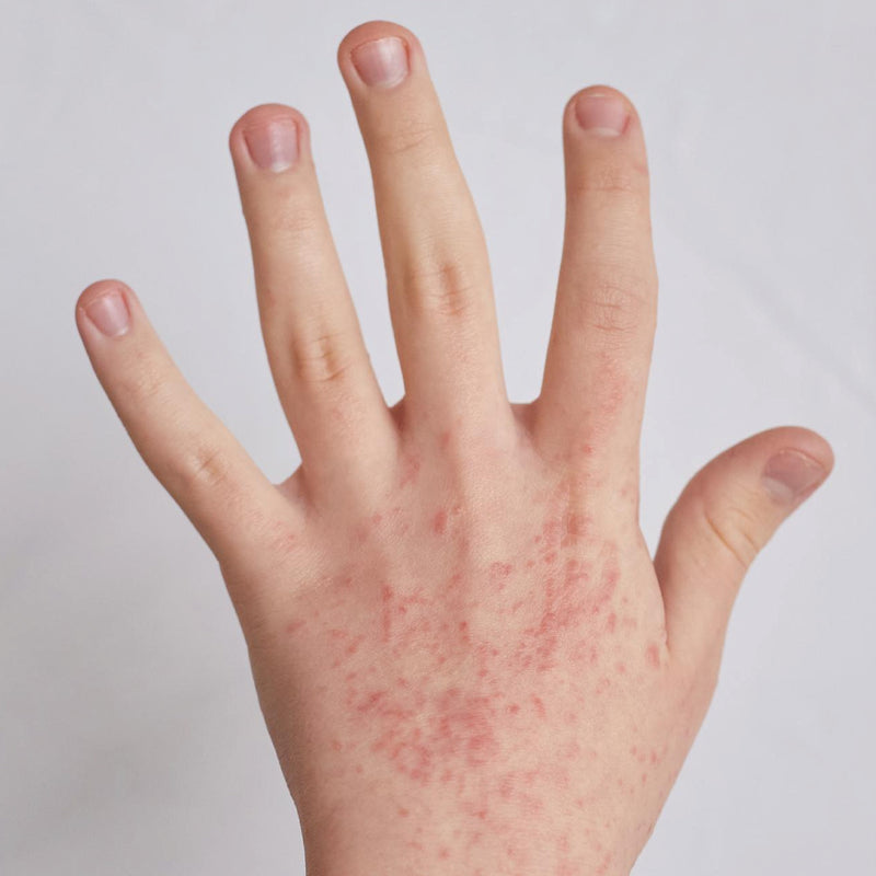 Eczema Relief