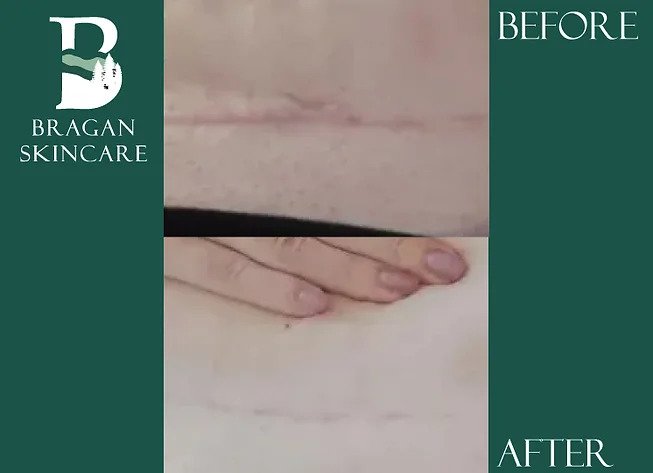 Scar tissue treatment. scar removal, C-section scar removal, chicken pox scars, acne scar treatment, scar treatment, acne scar removal, best acne scar treatment, scar treatment for face, scar revision,