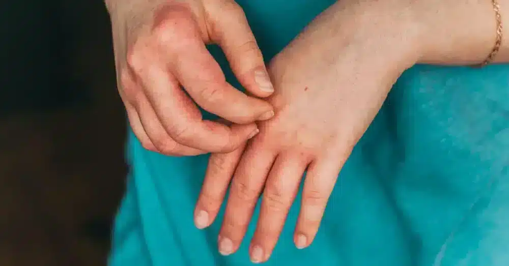 dermatitis rash,