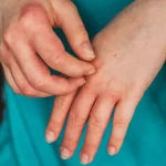 dermatitis rash,