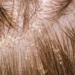 ​sebhorrheic dermatitis shampoo, best shampoo for seborrheic dermatitis, natural treatment for seborrheic dermatitis, seborrheic dermatitis scalp care, anti-dandruff shampoo for seborrheic dermatitis, seborrheic dermatitis scalp treatment, treat seborheic dermatitis, Gentle shampoo for sensitive scalp., fragrance free shampoo,shampoo for everyday use on sensitive scalp,