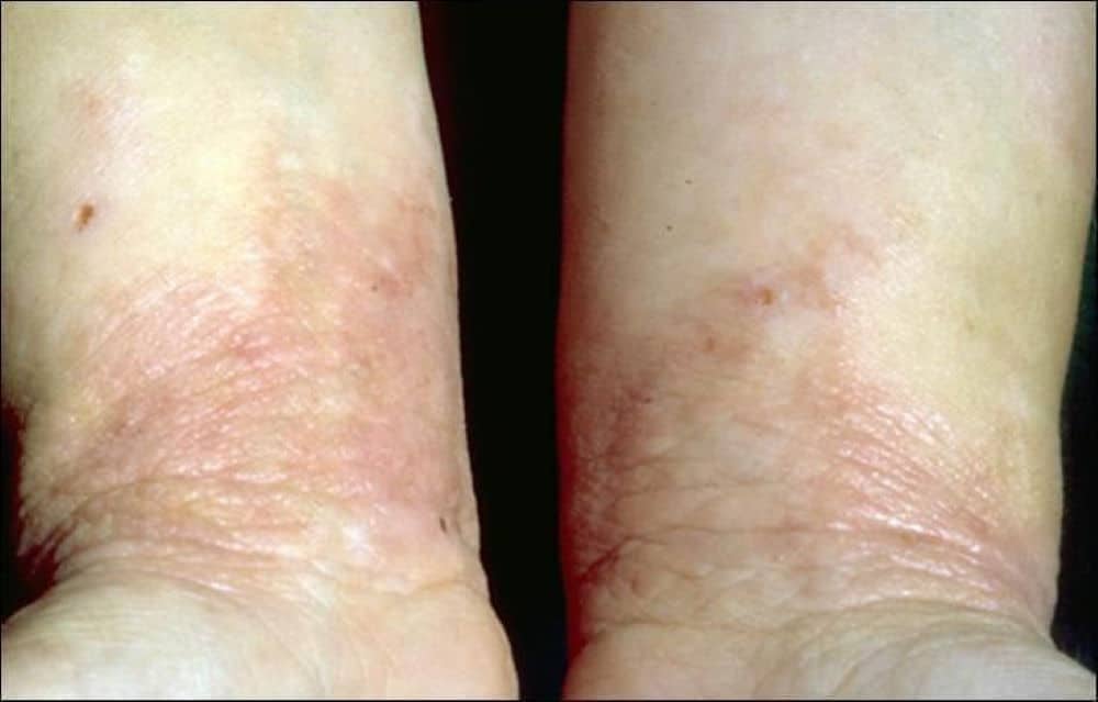 what causes eczema in adults