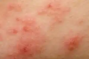 pubic area eczema, genital eczema, penile eczema, eczema on my penis, vulvar eczema, eczema on my privates,