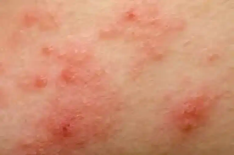 pubic area eczema, genital eczema, penile eczema, eczema on my penis, vulvar eczema, eczema on my privates,
