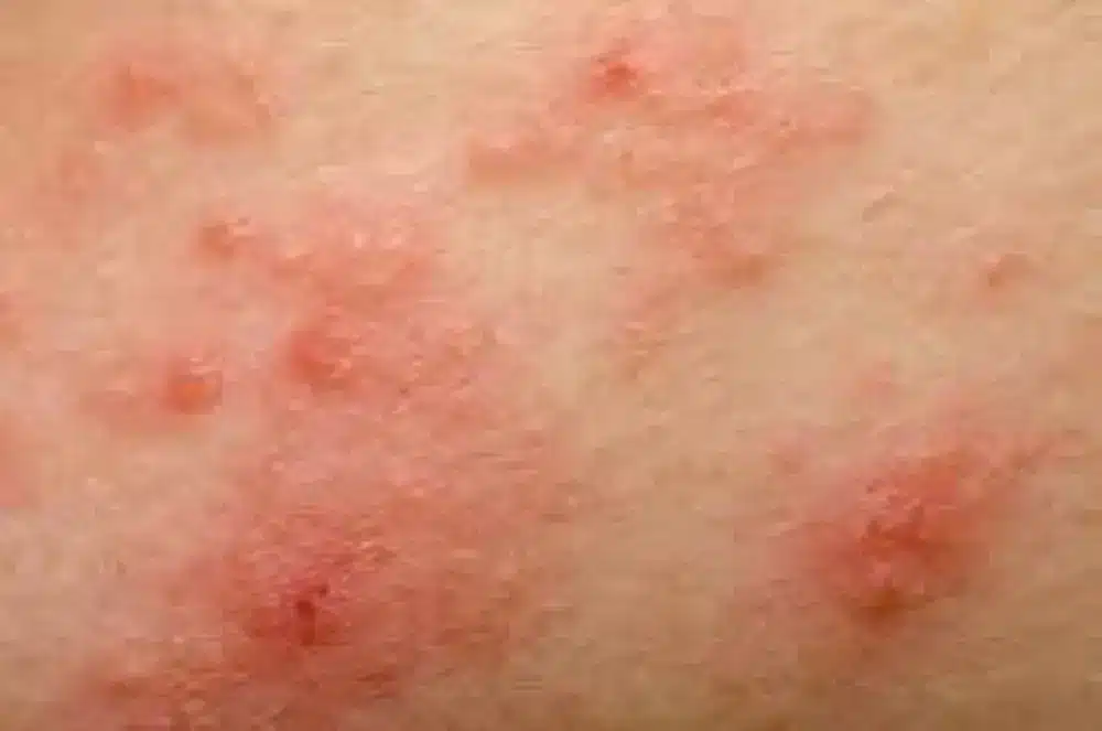 pubic area eczema, genital eczema, penile eczema, eczema on my penis, vulvar eczema, eczema on my privates,