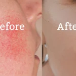 Atopic Eczema Cream, how to treat atopic dermatitis, best cream for seborrheic dermatitis, eczema treatment cream, treating eczema, atopic dermatitis treatment