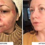 psoriasis treatment cream,