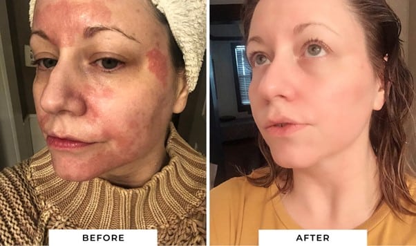 psoriasis treatment cream,