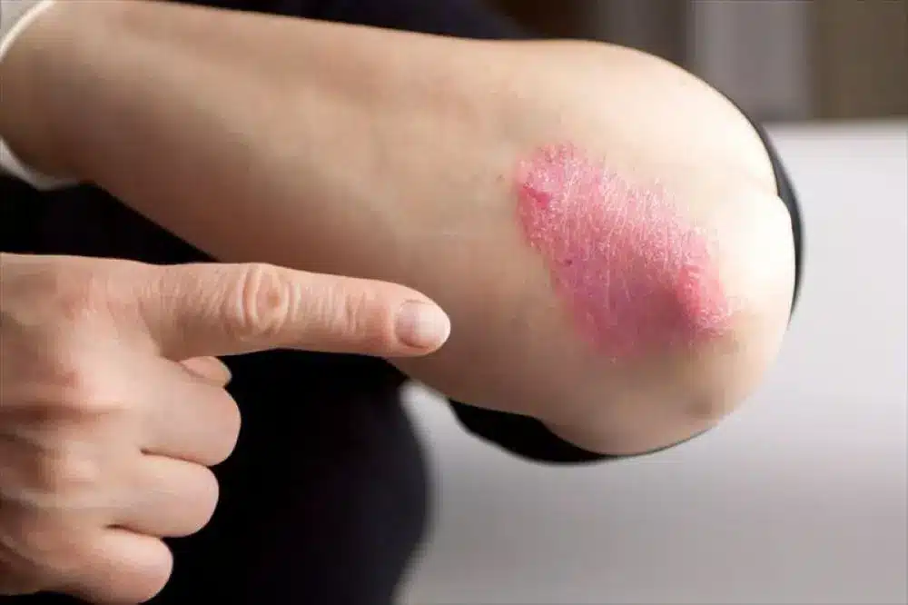eczema cream, atopic cream for sensitive skin, range/atopic-cream-50ml/eczema treatment cream,