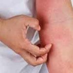 skin rash, contact dermatitis, dermatitis rash,