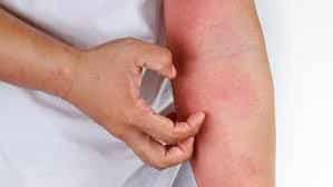 skin rash, contact dermatitis, dermatitis rash,