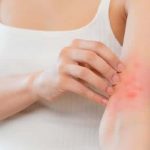 best cream for eczema itching, best lotions for eczema, good creams for dermatitis,