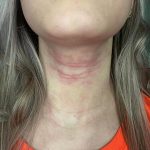 ​eczema CREAM, best eczema cream, eczema cream for kids, natural eczema cream, over-the-counter eczema cream, eczema cream, a good cream for psoriasis, Treatment for Eczema, atopic dermatitis treatment cream, Snail mucin eczema