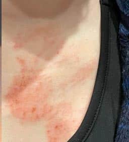 best psoriasis cream,