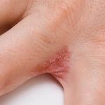 psoriasis treatment cream, best psoriasis cream, psoriasis ointment Ireland, natural psoriasis treatment, psoriasis relief cream, Dyshidrotic Eczema hands, for psoriasis cream, plaque psoriasis, (plaque cirrhosis)