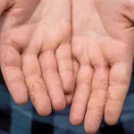 Natural Alternatives to Steroids for Dyshidrotic Eczema, Natural Alternatives to Steroids for Dyshidrotic Eczema, fingertip eczema