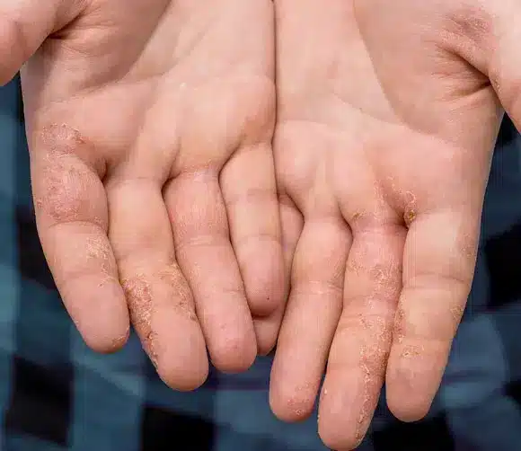 Natural Alternatives to Steroids for Dyshidrotic Eczema, Natural Alternatives to Steroids for Dyshidrotic Eczema, fingertip eczema