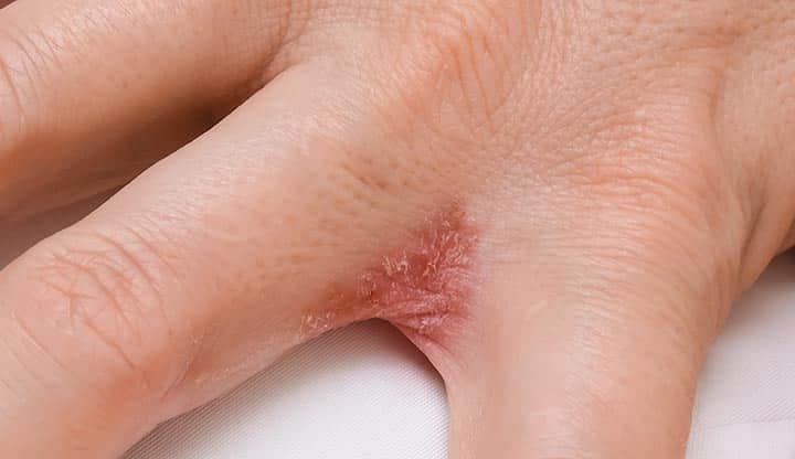 ​psoriasis treatment cream, best psoriasis cream, psoriasis ointment Ireland, natural psoriasis treatment, psoriasis relief cream, Dyshidrotic Eczema hands, for psoriasis cream, plaque psoriasis, (plaque cirrhosis)