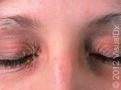seborrheic dermatitis on face,