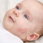 eczema CREAM, best eczema cream, eczema cream for kids, natural eczema cream, over-the-counter eczema cream, eczema cream, a good cream for psoriasis, Treatment for Eczema, Baby Eczema Cream using snail mucin