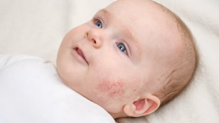 ​eczema CREAM, best eczema cream, eczema cream for kids, natural eczema cream, over-the-counter eczema cream, eczema cream, a good cream for psoriasis, Treatment for Eczema, Baby Eczema Cream using snail mucin