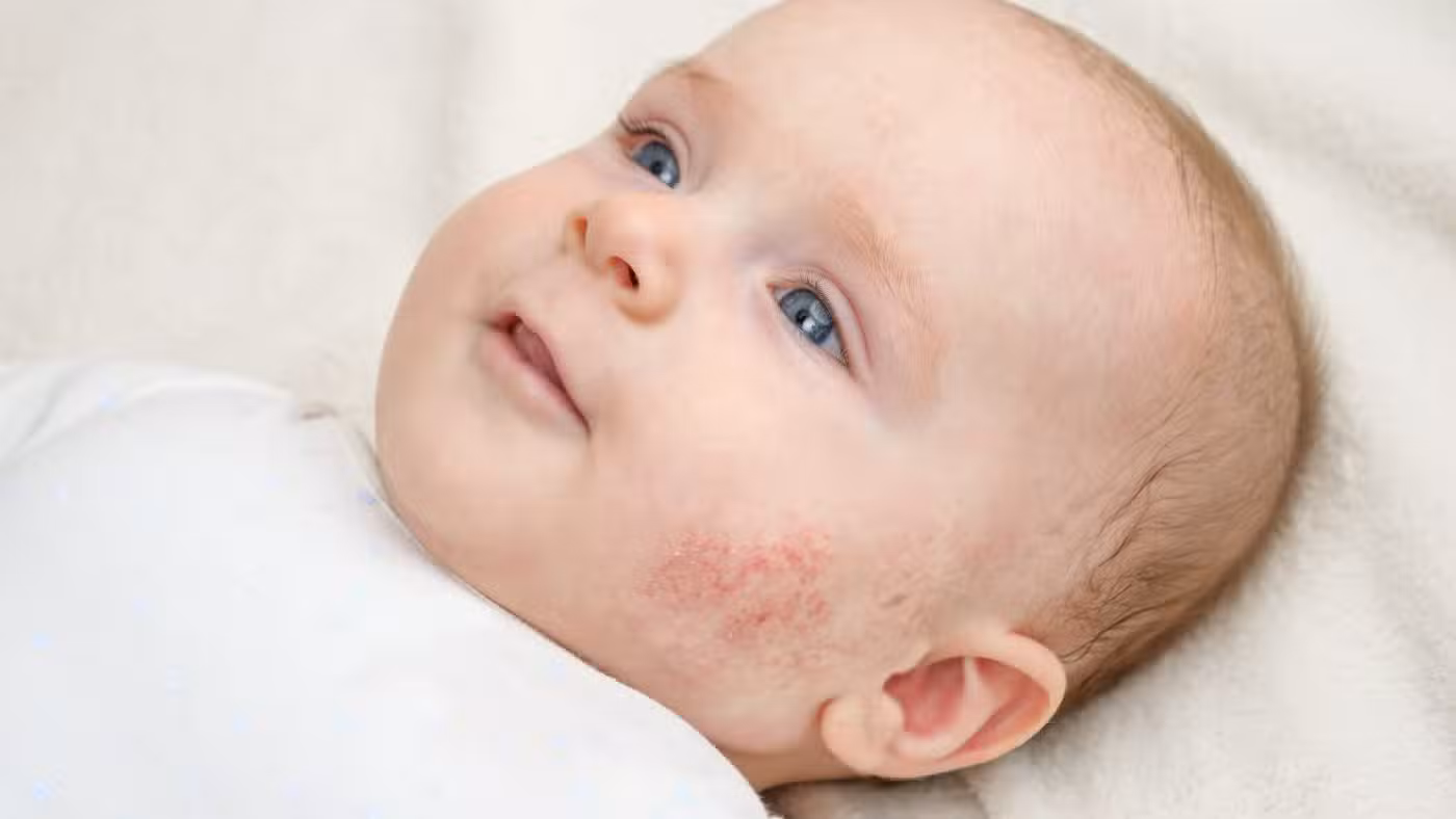 ​baby with eczema on cheek