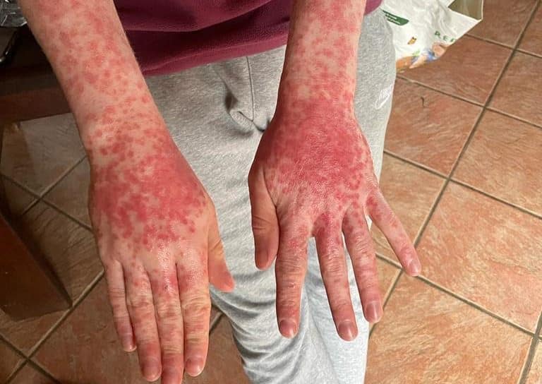 eczema on the hands