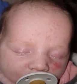 ​eczema CREAM, best eczema cream, eczema cream for kids, natural eczema cream, over-the-counter eczema cream, eczema cream, a good cream for psoriasis, Treatment for Eczema