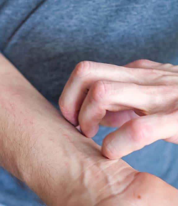 Dermatitis Skin Condition