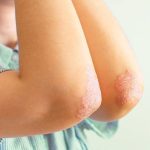 contact dermatitis, Treat Eczema Skin Condition