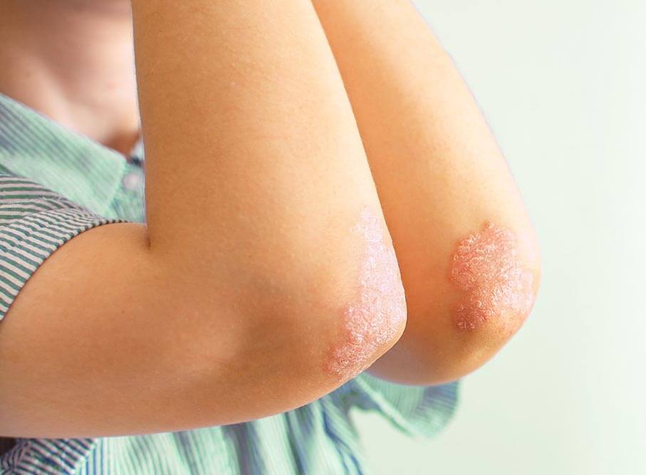 contact dermatitis, Treat Eczema Skin Condition