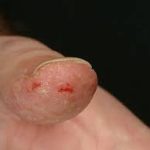 Fingertip-Dermatitis