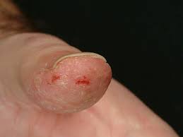 Fingertip-Dermatitis