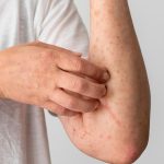 what causes eczema in adults, Psoriasis Skin Condition