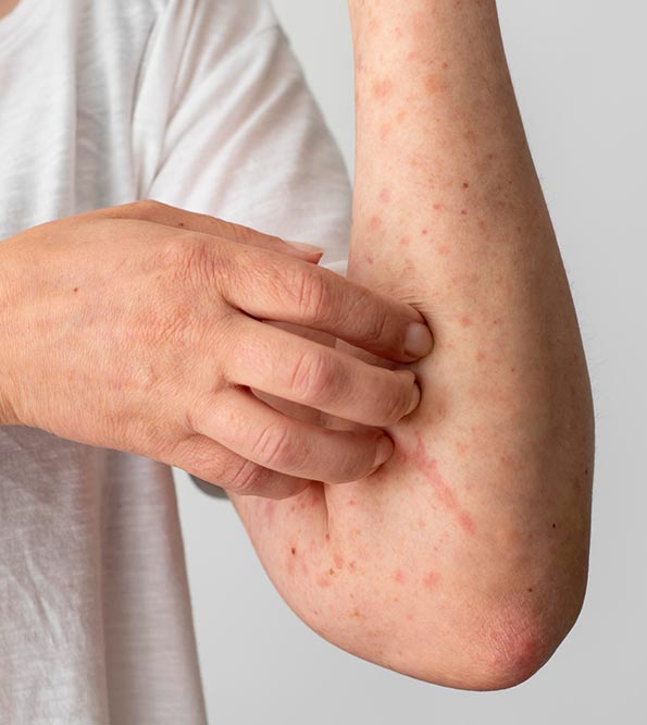 what causes eczema in adults, Psoriasis Skin Condition