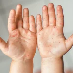 Contact eczema on dry cracked hands – example of irritant dermatitis