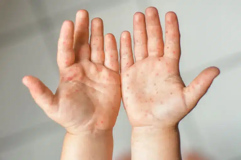 Contact Eczema Treatment, dyshidrotic eczema, eczema on hands, dermatitis on hands, contact dermatitis in hands, stress related eczema on hands, treatment for dyshidrosis,hand eczema treatment, dermatitis on fingers, dyshidrosis eczema, hand cream for eczema, hand dermatitis treatment, winter eczema on hands, dyshidrotic eczema fingers, dyshidrotic eczema pregnancy, dyshidriotic cream,